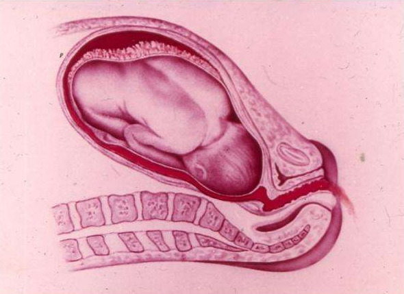 Décollement placentaire prématuré: causes, symptômes, traitement