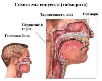 sinuzita nasului