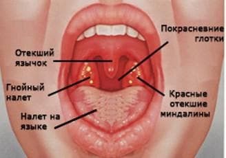 purulent sore throat