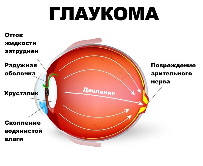 Doutrot - øjendråber for at reducere intraokulært tryk