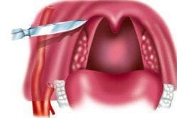 Sådan genkender man en paratonsillar abscess: de vigtigste symptomer